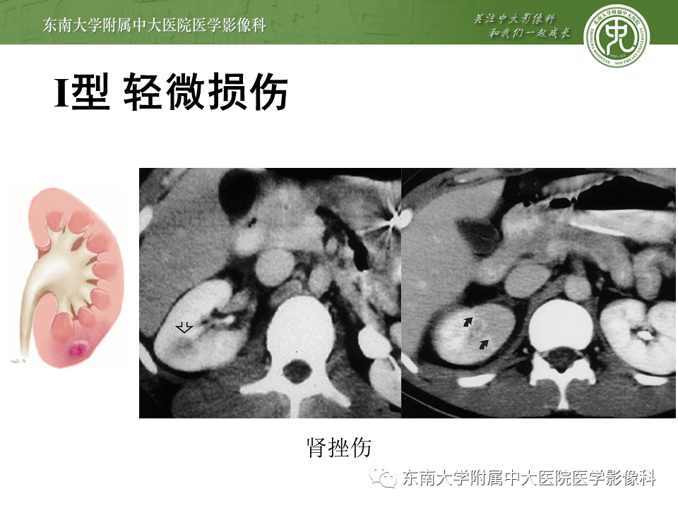 病例结果:右侧多发肾裂伤编辑/校对:郑孝飞增强ct男,46岁,因"外伤后