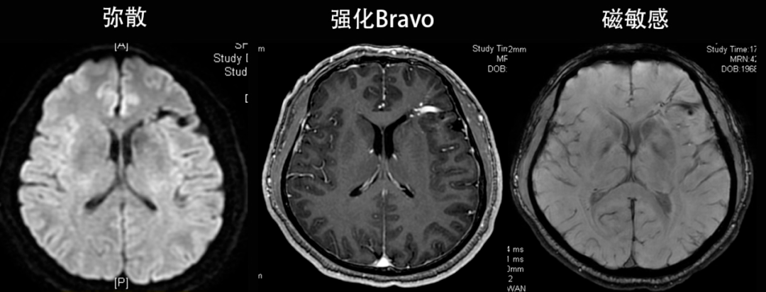 大脑大静脉池磁共振图片