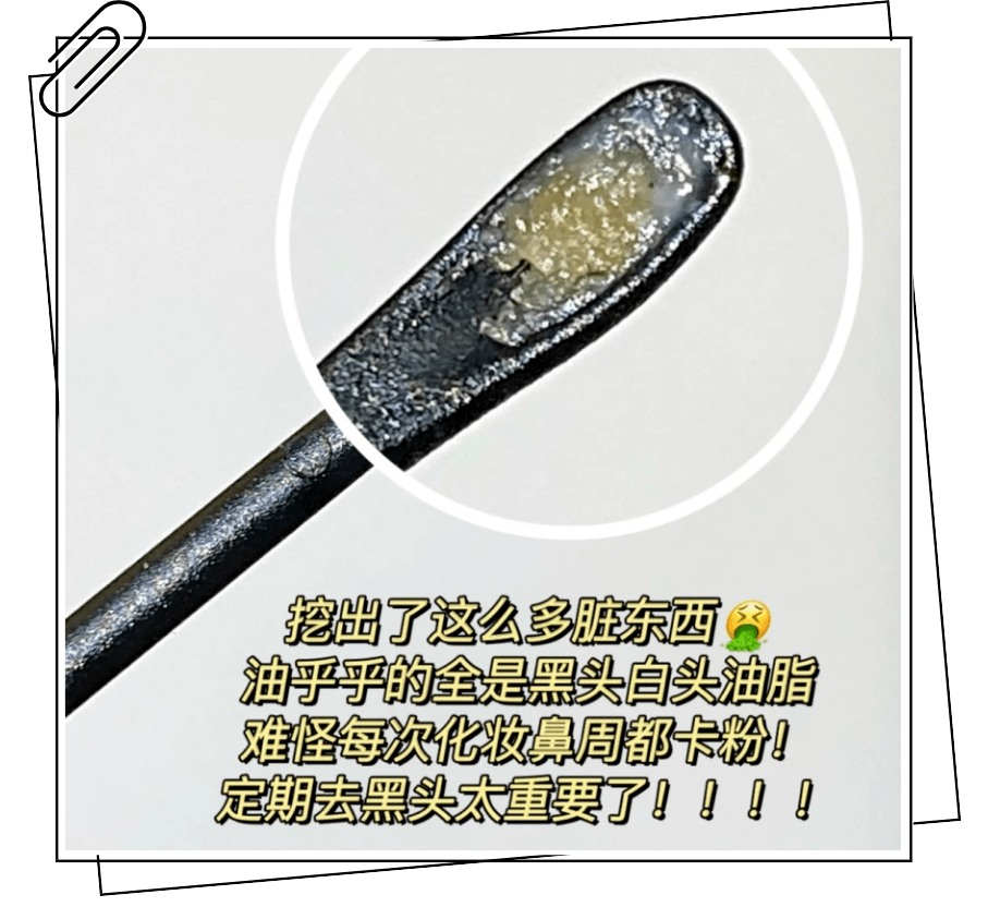 黑头|这张脸，我看了就想吐