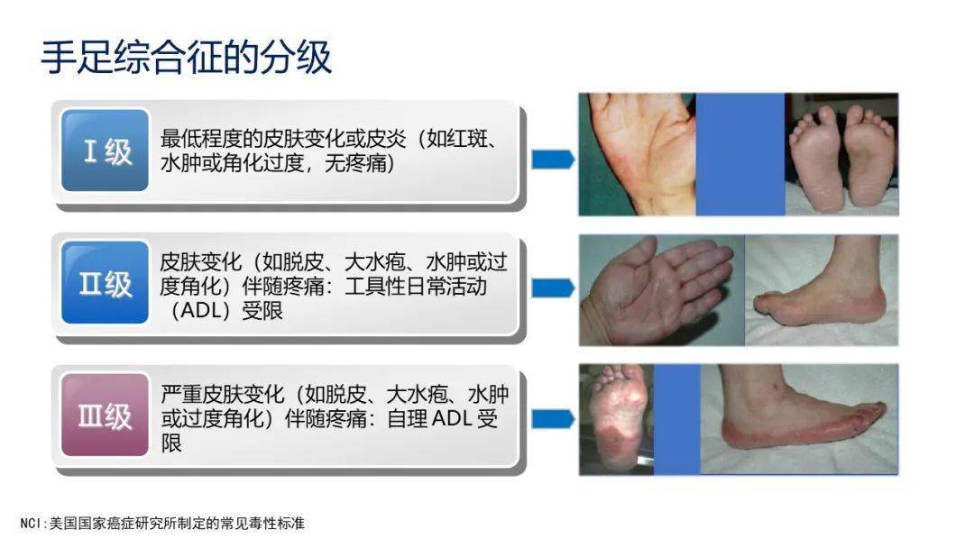 【周四讲堂】手足综合征的观察与护理