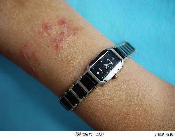 丘疹性荨麻疹蚊虫喜欢潮湿,阴凉的地方,降水增加,蚊虫自然而然的多了.