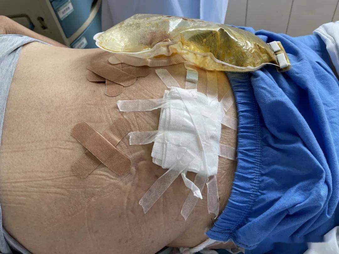 小心直肠破裂!常德市第一中医医院专家提醒:下面塞药别乱来