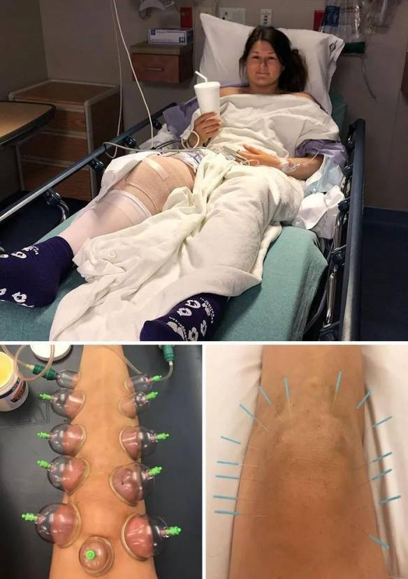 珍妮丝·布拉科维奇在比赛后的腿