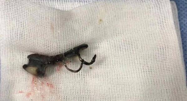 假牙|消失的假牙钩在气管上，杭州大伯“心肺都要咳出来”！这些动作不要再做了！