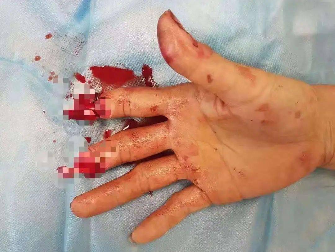 前方高能!一女子手指不慎被机器绞断,医生移花接木断指重获新生