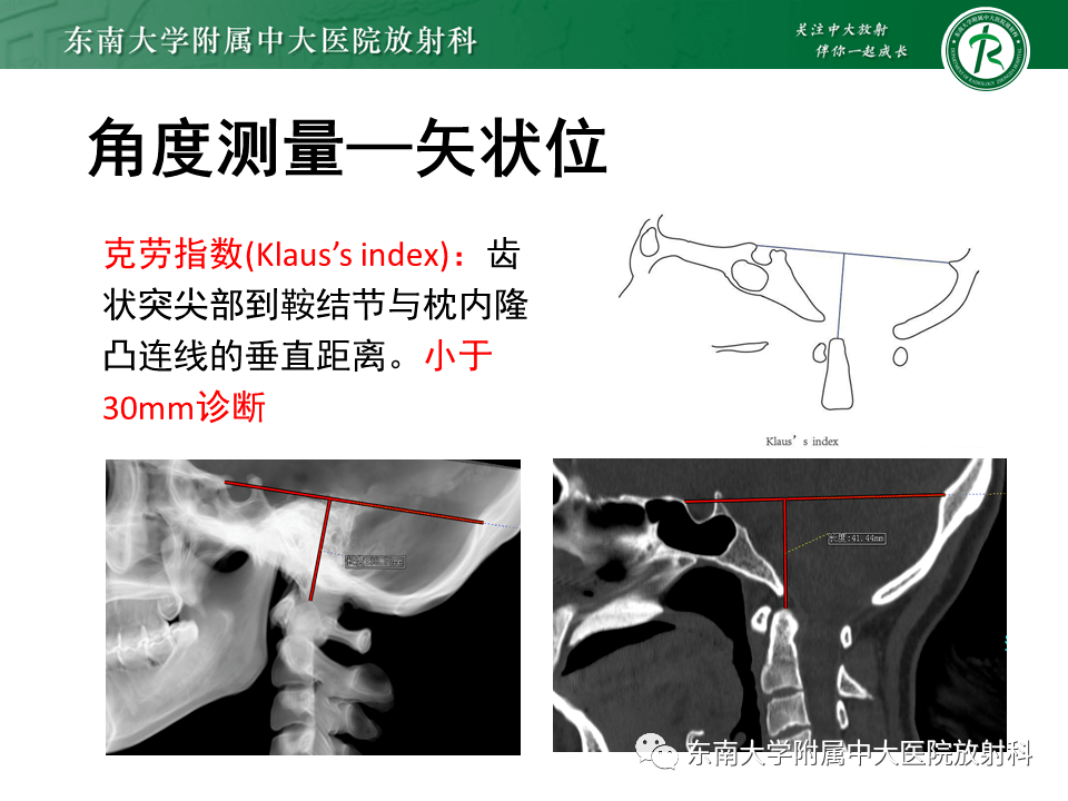 晨讀結果公佈20210805肌骨系統顱底凹陷症伴寰樞關節半脫位寰枕融合