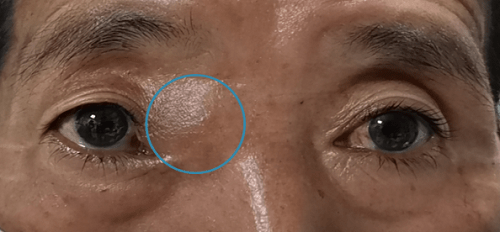 眼眶|眼科大咖领衔，爱尔眼科成都三院联合为患者拆除眼眶“炸弹”