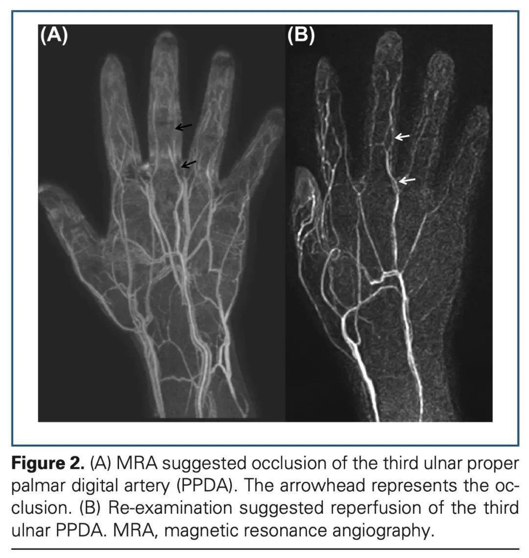 磁共振血管造影检查发现,第三尺骨指掌侧固有动脉阻塞(图2-a.