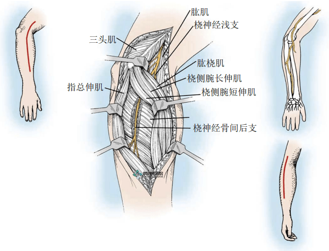 肘管综合征解剖图图片