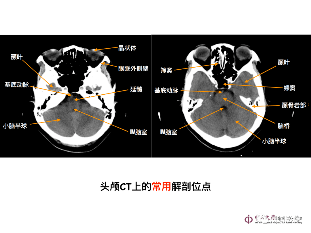 头颅CT片子图片