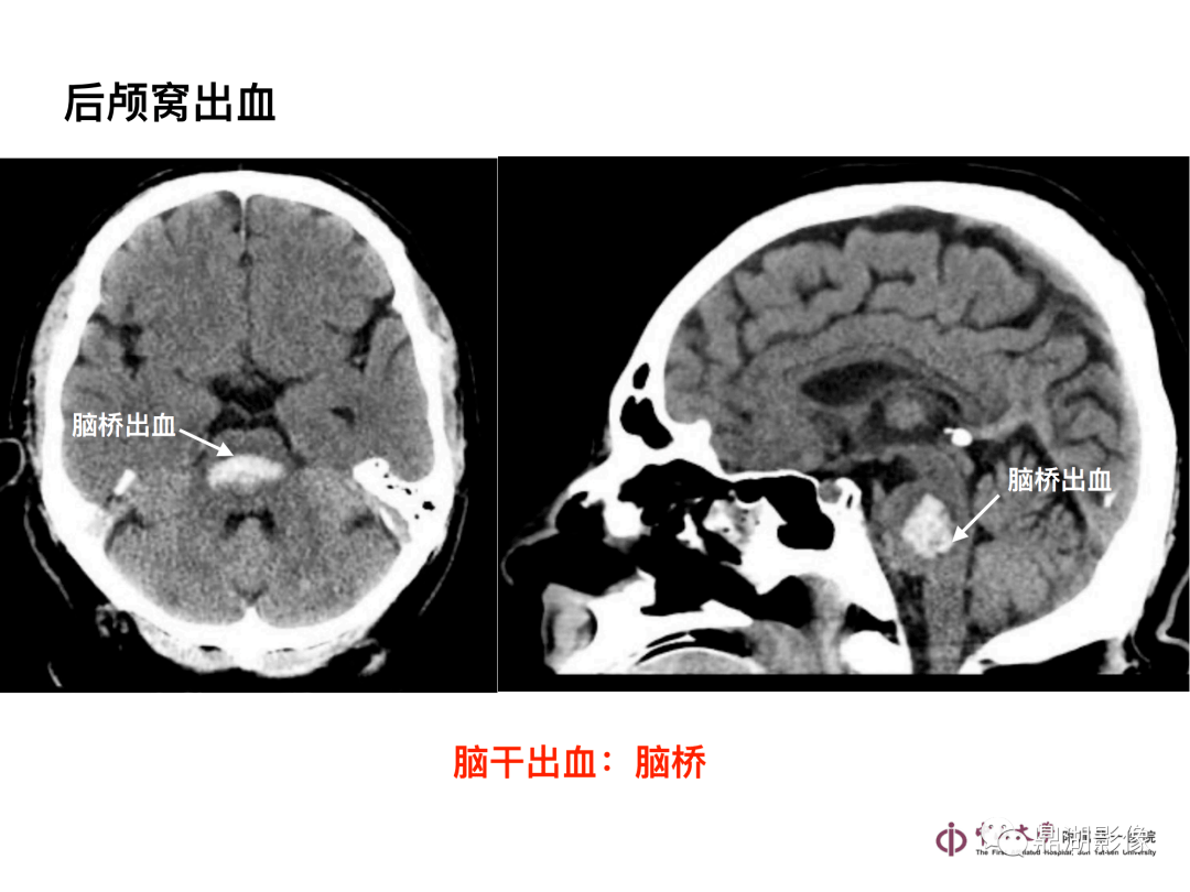 超實用急診頭顱ct3b閱片法