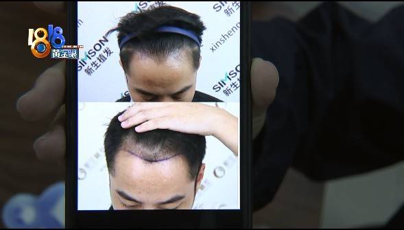 效果|90后“新生植发” 两年后“又见稀疏”