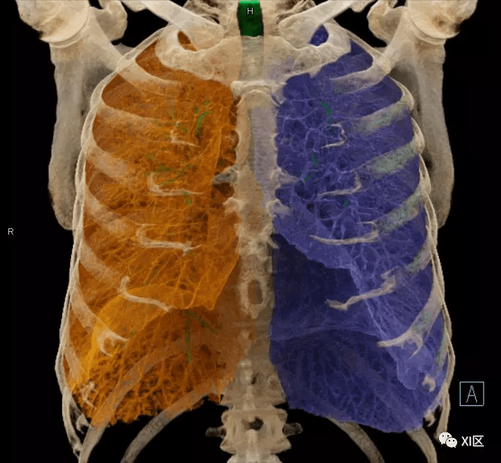 如此詳細的肺部影像解剖,有點兒酷_氣管