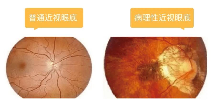 学龄前不检查视力孩子更有可能近视