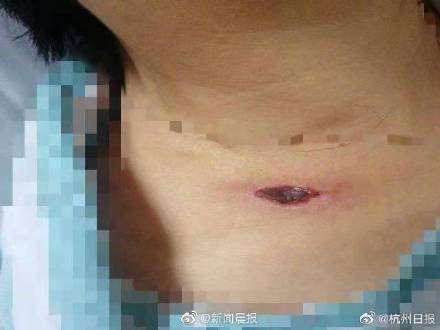 皮肤|杭州大妈跳广场舞被虫咬后病危