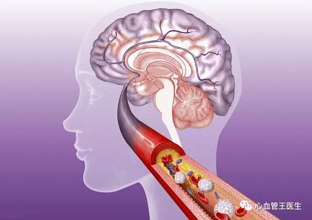 治疗|吃着阿司匹林和他汀二次脑梗？医生辟谣：不同脑梗服药不同！