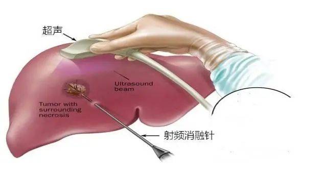 67一根针19分钟肿瘤消融了市人民医院成功开展首例这类手术