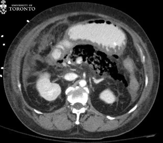 治疗|精选病例:典型的急性坏死性胰腺炎