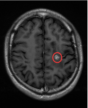 核心|七八年前生吞蛇胆不下十次，而今脑内长虫险些破坏核心功能