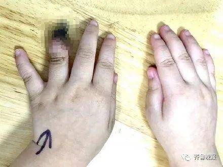 错误|包扎不当致3岁女童被截指，这个错误家长要小心