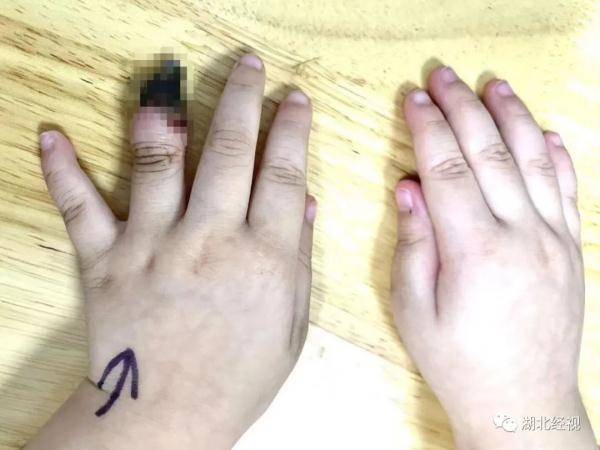 伤口|痛心！3岁女童竟因此被截掉手指