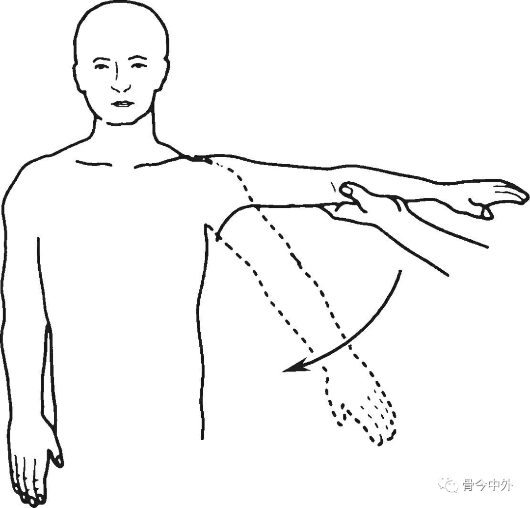 冈上肌撞击试验(hawkin试验)患者站立,肩外展90°,检查者内旋患者肩