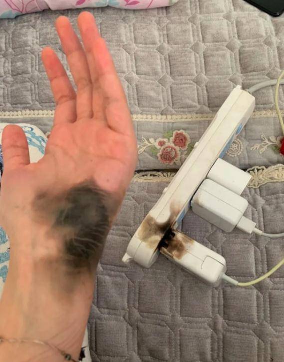 充电|女子拔插头引发爆炸，手掌黑了一大片！原因竟是……