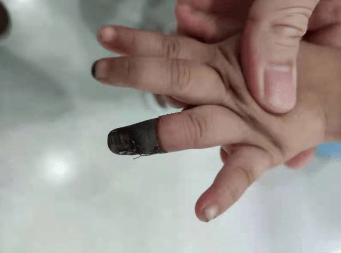 肌腱|奶奶一个动作，3岁女童手指没了一截！这个错很多人会犯