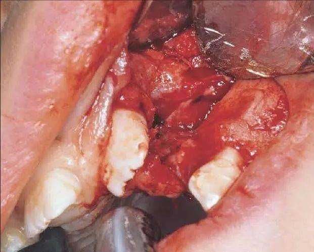 利用发育中的牙齿成骨