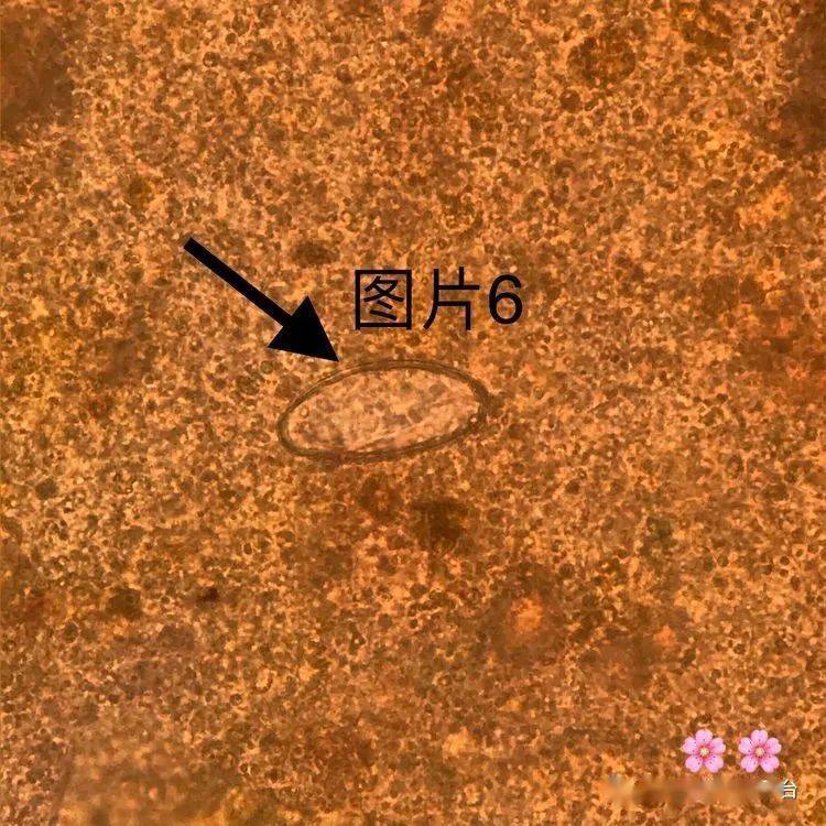 内含的屈光颗粒常因透明而消失,卵壳薄,易于变形,形态易与血吸虫卵相