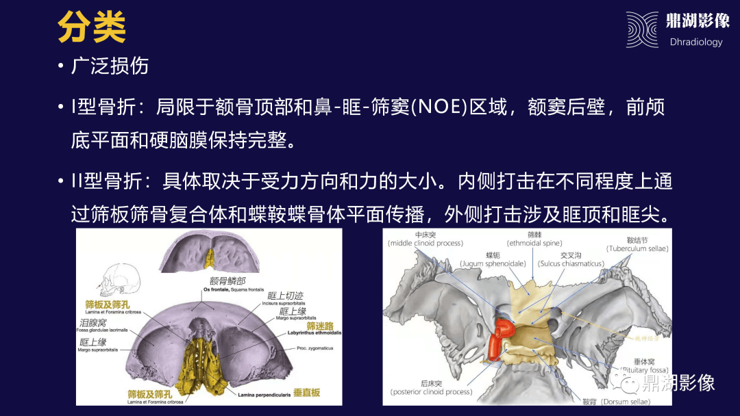 the otic capsule or osseous (bony) labyrinth:耳軟骨囊或骨迷路是