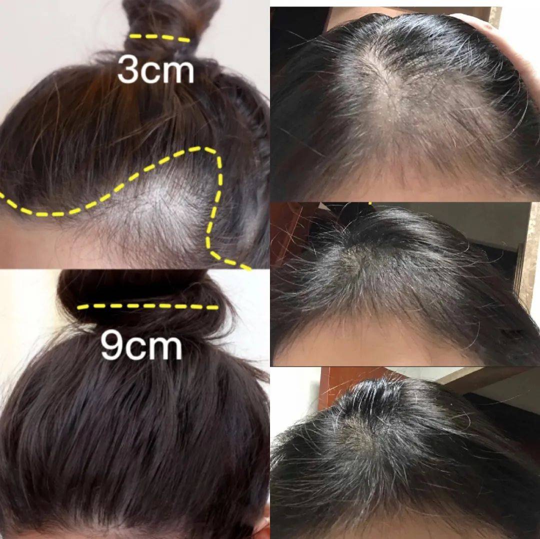 洗头|脱发、秃头，又丑又显老！这样做，头发浓密，更显年轻好气质