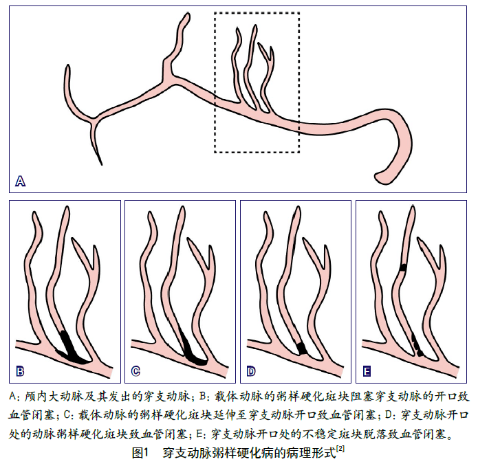 血管|《穿支动脉粥样硬化病中国专家共识》解读