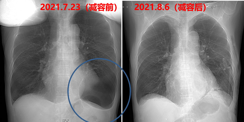 肺怕结节运动是什么病_肺部结节运动能改善吗_肺结节最怕三种运动是什么