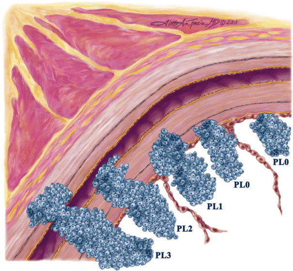 肿瘤|这部分患者或可免去化疗！杨浩贤团队研究成果为早期肺癌患者带来福音