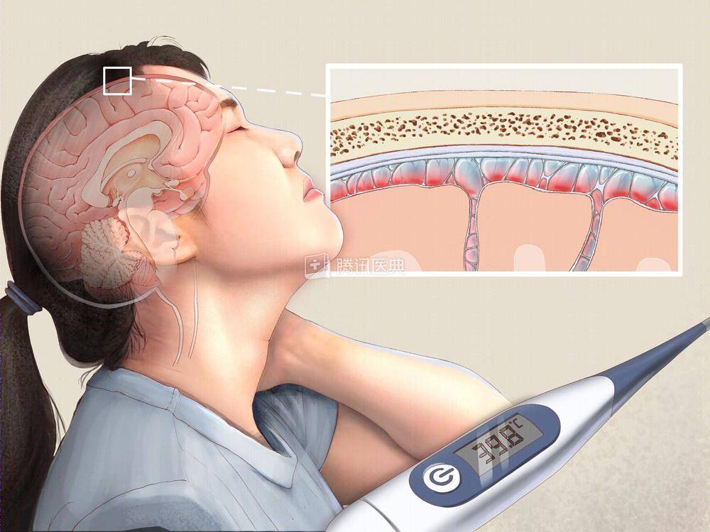 李斯特|一碗剩鸡汤，竟喝出脑膜炎？食物隔夜注意这4点