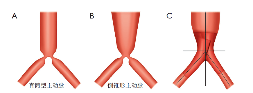 主髂動脈血管成形術血管和血管腔內手術要領與圖解新書搶鮮看