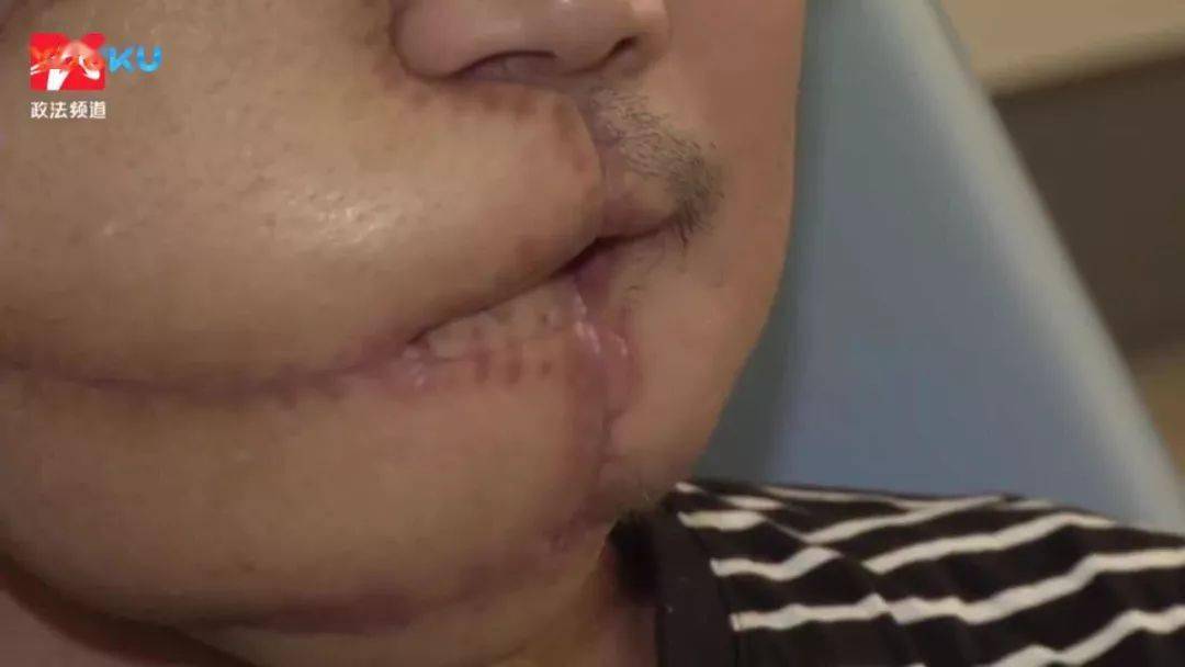 我是口腔医生我真心希望大家千万不要再吃槟榔了