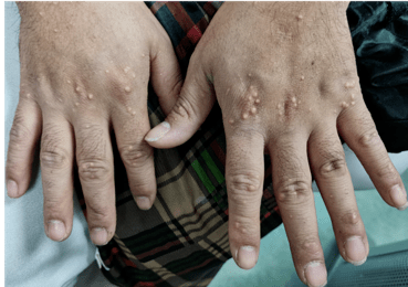 上肢多发黄色素瘤,小心心脏血栓堵塞