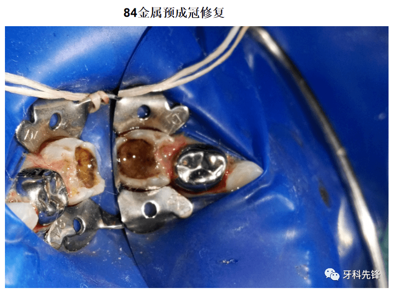 儿童牙龈瘘管怎么治疗图片