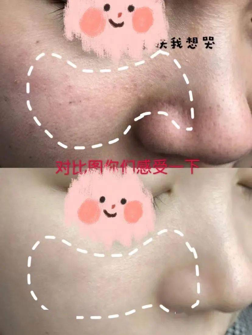 黑头|阿娇没骗我！2块钱敷一次酸，脸上“小疙瘩”竟被吞了！