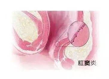 大便时肛门疼痛怎么回事?大多是疾病信号
