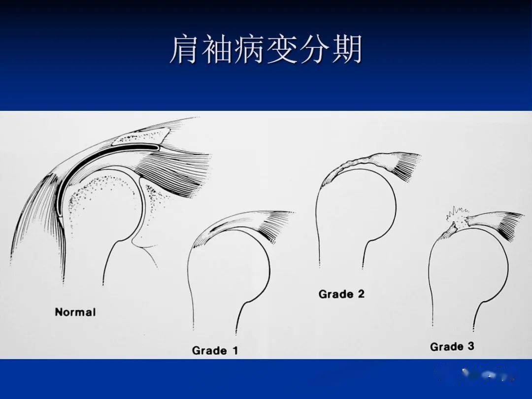 其中后两者不参与肩袖构成;肱二头肌属于上肢肌.