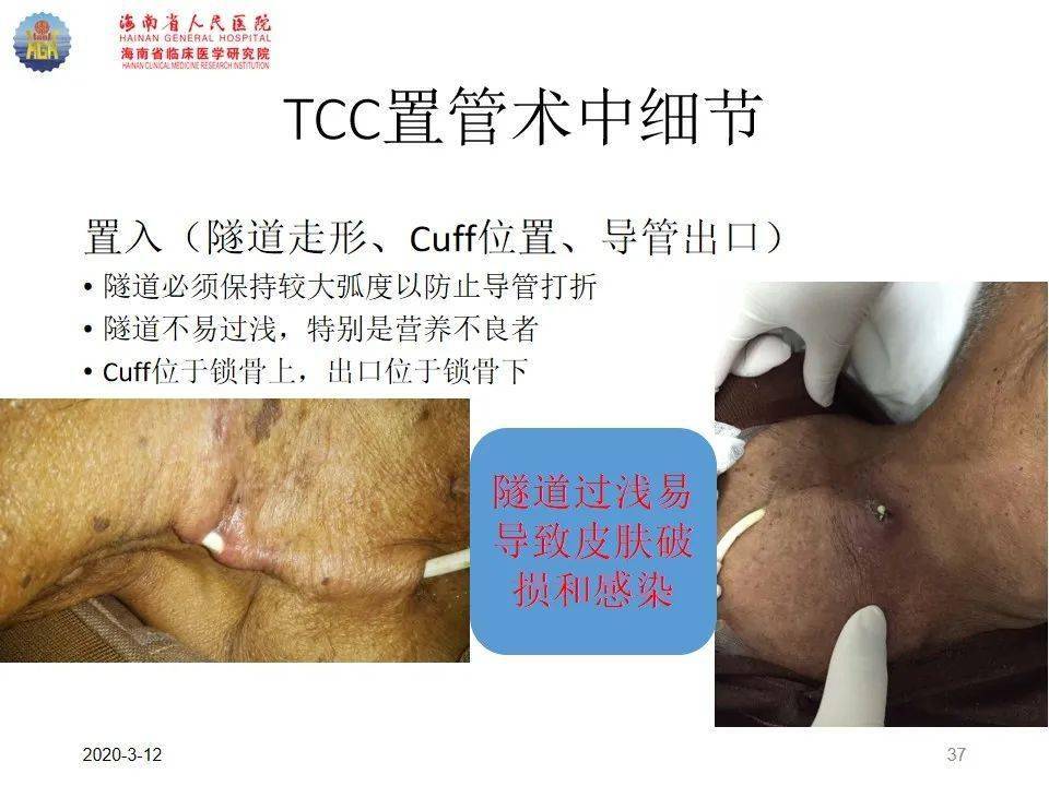 【ppt】血液透析长期导管置管技巧