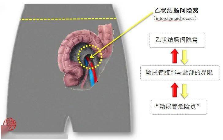 医学图说乙状结肠间隐窝的应用解剖学