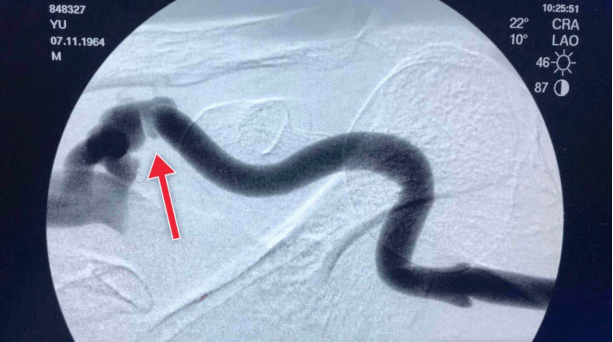 进行|【医患一家】精益求精,迎难而上,肾内科为血液透析患者重建“生命线”