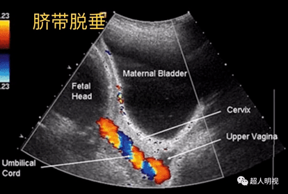 羊膜囊突入宫颈管图片