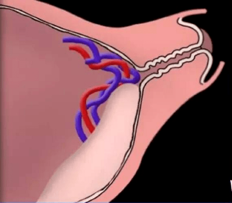 血管前置产前超声诊断二