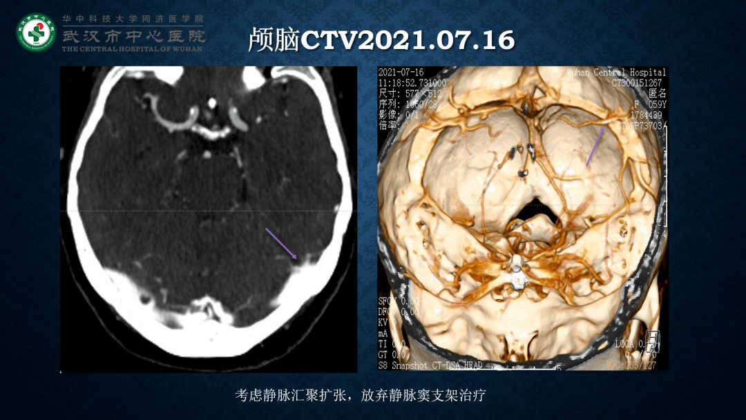 脑回压迹图片