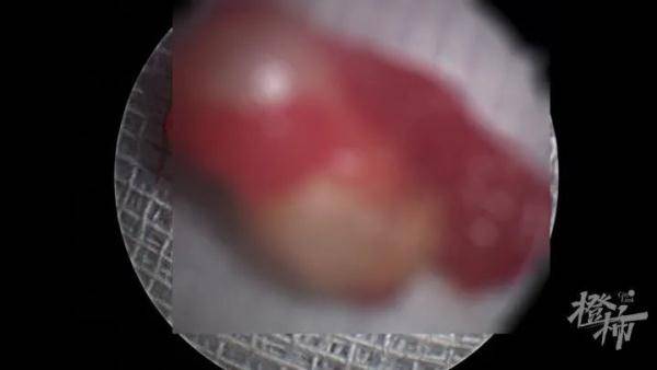 畸形|6岁女童鼻子里“长牙”！孩子出现这些症状，家长要当心